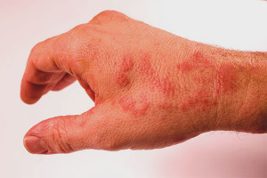 How to get rid of urticaria