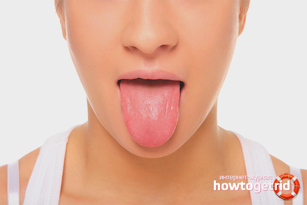 Dilde plak ile hastalığın tanımı