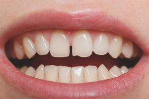 Как да премахнете празнината между предните зъби