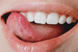 Come sbarazzarsi di acne nella lingua