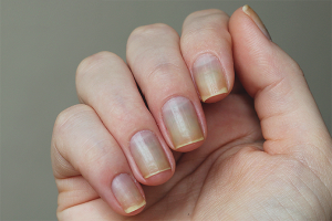How to restore nails after gel polish