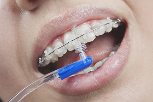 Jak si čistit zuby rovnátka