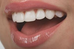 כיצד לחזק שיניים אם הן נשברות
