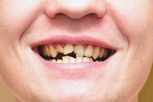 O que fazer se os dentes desmoronarem