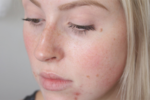 Come rimuovere i segni dell'acne sul viso