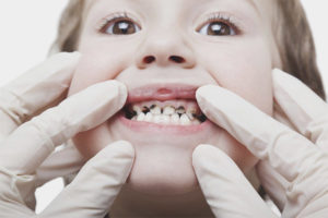 Svart plack på tänderna på ett barn
