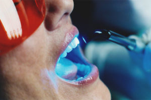 Laser Zahnaufhellung