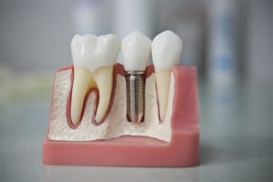 Zobu implantācija