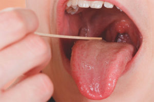 Is it possible to cure a sore throat without antibiotics